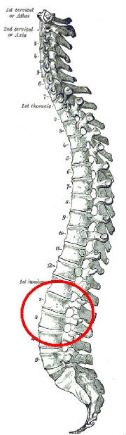 Hernia Lumbar