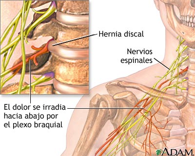 Hernia Discal en las cervicales